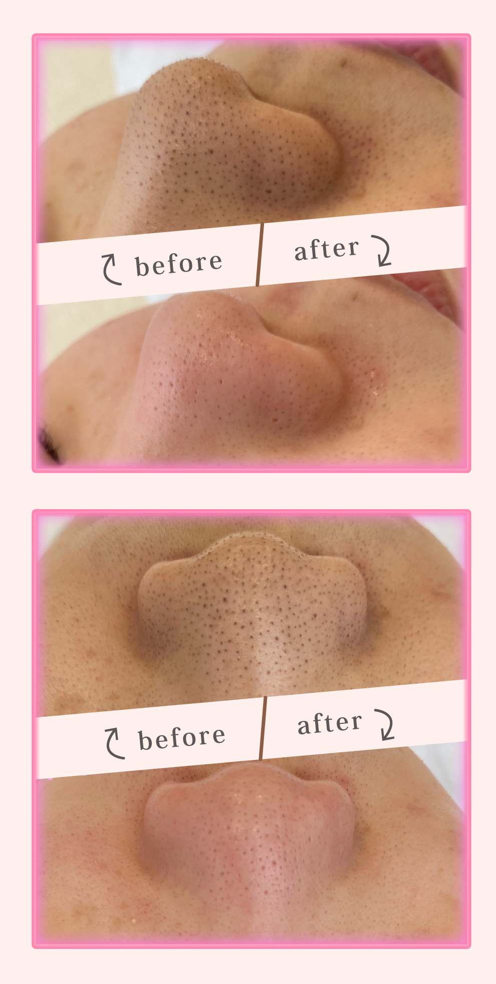 繰り返す毛穴トラブル。beforeafter